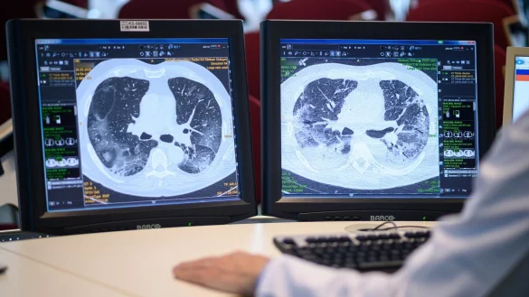 Schwerer Krankheitsverlauf bei Covid-19 - &copy; Foto: Sebastian Gollnow/dpa