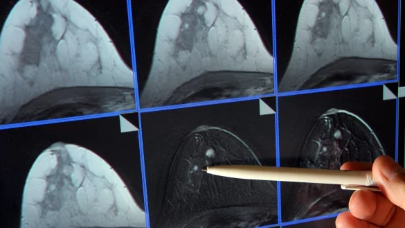 Tumor - &copy; Foto: Jan-Peter Kasper