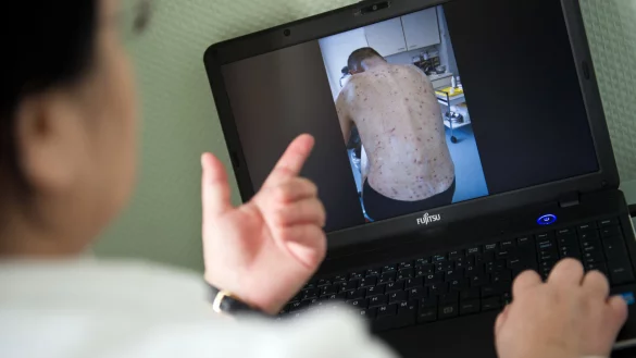 Wenn Krätzmilben nicht behandelt werden, breitet sich der Parasit weiter aus. - © Daniel Naupold/dpa