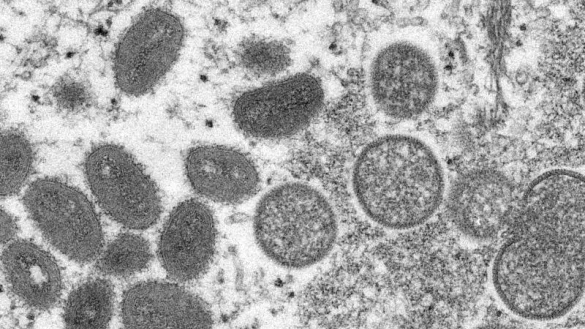 Affenpocken - &copy; Foto: Cynthia S. Goldsmith/Russell Regner/CDC/AP/dpa